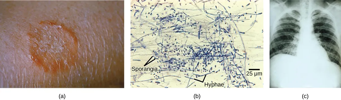 Part A is a photo of a red, ring-shaped skin lesion. Part B is a micrograph of long, thread-like mycelia and small, oval sporangia. Part C is a chest X-ray of a person with a fungal infection.