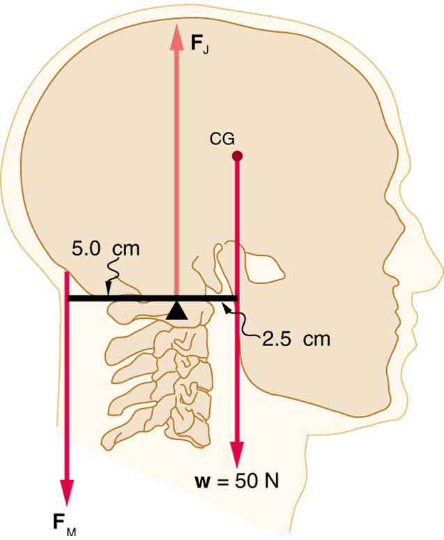 An erect head is shown. The weight of the head is fifty newtons. The center of gravity of the head lies in front of its support. The perpendicular distance between the support and the weight of the head is two point five centimeters. Between these forces, there is a point where a vertical force vector is shown. This force is marked as F sub J. At the back of the head, five point zero centimeters behind the support point, is a downward vector labeled F sub m.