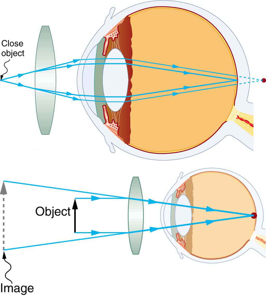 Two illustrations of a cross-sectional view of an eye are shown. In the upper part of the figure, a converging lens is placed in front of the eye structure and a close object before it. A ray diagram showing the rays from the object are striking the lens; converging a bit and entering the eyes; converging again through the eye lens and forming an image at the retina, and another set of rays converge behind the retina. The lower part of the figure shows a virtual image, an object, a converging lens, and the internal structure of an eye. Parallel rays from the object are entering the eyes and converging at a point on the retina. An image larger than the object image is formed behind the object on the same side of the lens.