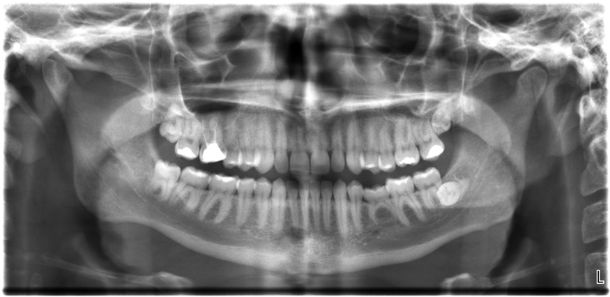 The X-ray image of front view of the jaw, especially the teeth.