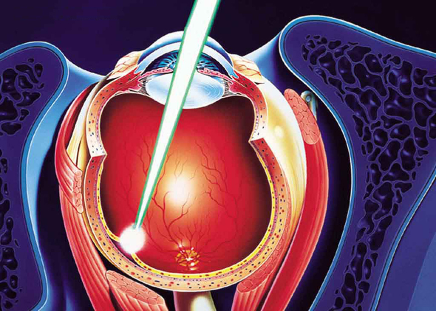 The image shows the retina of a human eye. Only a small spot on the retina is burned by a laser without affecting other areas of the retina.