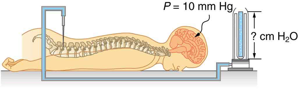 Diagram of a person lying face-down on a table hooked up to a medical apparatus. A needle attached to a tube is inserted between the patient’s vertebrae in the lower back area. The tube, which appears to be filled with fluid, is connected to an upright tube containing an unknown amount of water. The height of the water in the tube is labeled question-mark centimeters H 2 O. A label pointing to the patient’s head reads P equals ten millimeters H g.