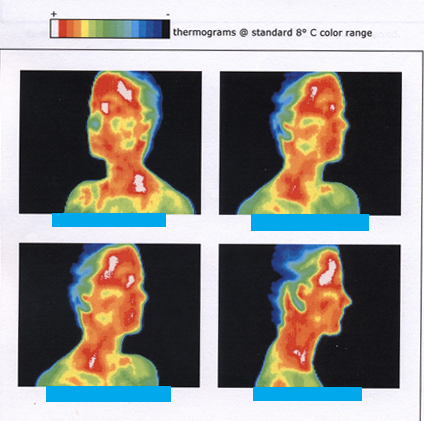 This figure consists of four different infrared thermographs of a person's head and neck, taken when the person's head was positioned at four different angles. The person's face and neck are mostly red and orange, with patches of white, green, and yellow. The red and white colors correspond to hot areas. The person's hair ranges in color from green to light blue to dark blue. The blue color corresponds to cold areas.